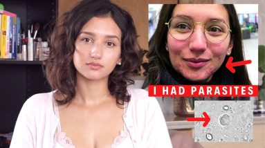 I HAD PARASITES | Itchy Skin, Acne, Bad Digestion | How I treated it (not natural) 14 1681094847 maxresdefault