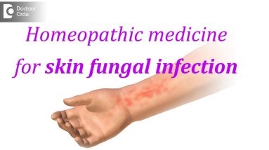 Homeopathic medicine for skin fungal infection - Dr. Surekha Tiwari 14 1681095137 maxresdefault