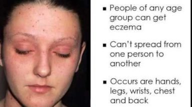 Best Natural Remedies for Eczema 2 1681103674 hqdefault