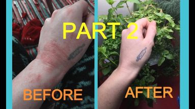How to heal your Eczema | PART 2 20 1681104922 maxresdefault