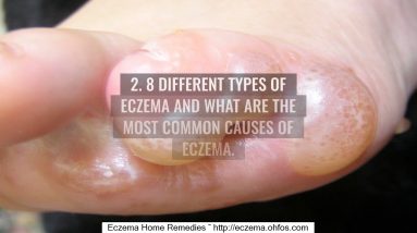 How To Treat Oozing Eczema 16 1681106460 maxresdefault
