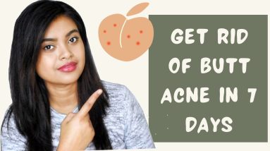How to Get Rid of Butt Acne in 7 Days | Butt Acne Treatment | Natural Ways to Stop Butt Acne 12 1681106727 maxresdefault