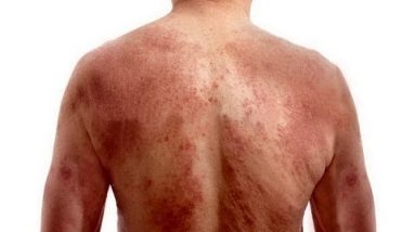 How to Treat Eczema Naturally - Natural Treatments for Cure Eczema 2 1681110125 hqdefault