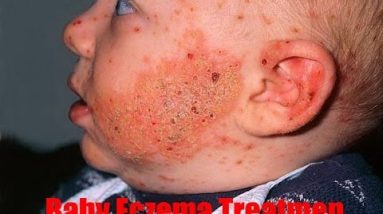 How to Treat Baby Eczema Naturally : Natural Treatment For Baby Eczema 8 1681113764 hqdefault
