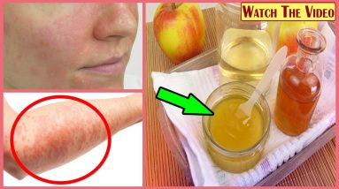 How To Cure Eczema With Apple Cider Vinegar 4 1681113990 maxresdefault