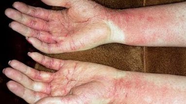 How to Treat Eczema on Hands - 4 Effective Eczema Home Treatment for Hands 20 1681121303 hqdefault