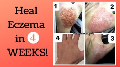 HOW TO HEAL ECZEMA FAST - NUTRITIONIST RECOMMENDED - FOOD, SUPPLEMENTS & NATURAL CREAMS 14 1681129724 maxresdefault