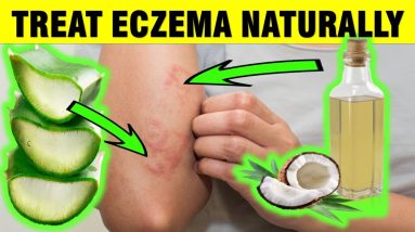 How to Treat Eczema Naturally 20 1681131443 maxresdefault