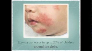 How To Treat Eczema in Children 18 1681132349 hqdefault