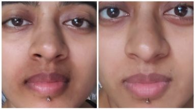 How I ACTUALLY got Rid of Pigmentation Around my Mouth || Pigmentation Treatment For Mouth Darkness 10 1681137120 maxresdefault