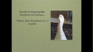 Zell-Arazim Homeopathic Pharmacy: How to Treat your Eczema Naturally 16 1681137222 hqdefault