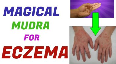 Mudra For Eczema/Hand mudra For Eczema/Eczema Treatment In Hindi Language/Eczema Mudra 14 1681164827 maxresdefault