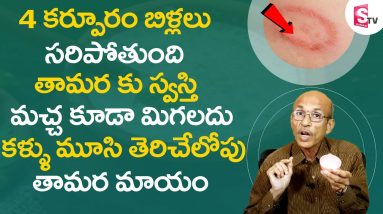 కళ్ళు మూసి తెరిచేలోపు తామర మాయం - ECZEMA SKIN DISEASES - Tamara Home Tips @SumanTVAyurvedam 2 1681205123 maxresdefault