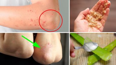4 Home Remedies for Dry Skin, Bumps & Rash on Elbows 20 1681210797 maxresdefault