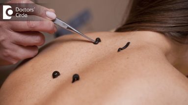 Leech therapy and its benefits - Dr. Priya Jain 16 1681217575 maxresdefault