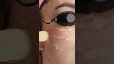 How To Blackheads Remove | How to Exfoliation at Home | Acnes Pimples and Pimple's Spots Removal 2 1681221271 maxresdefault
