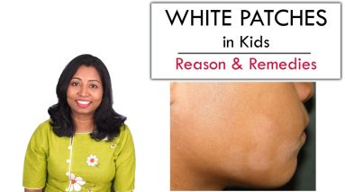 White Patches in Kids face – Reason, Care & Remedy 12 1681223678 maxresdefault