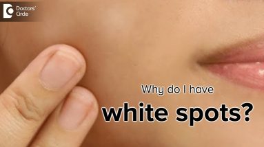 What is the cause of white spots on the skin? - Dr. Rasya Dixit 16 1681227892 maxresdefault