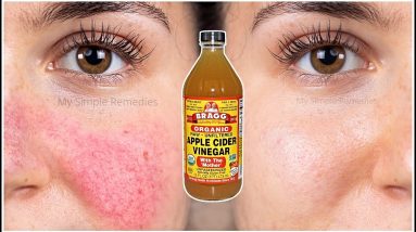 How To Remove Eczema, Blemishes, Acne Marks & Age Spots (100% Effective) Tested Proven Way 4 1681231058 maxresdefault