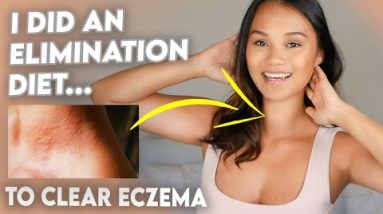 How I Cleared My Eczema with an Elimination Diet! 2 1681231599 hqdefault