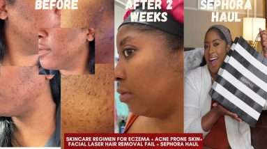 SKIN CARE REGIMEN FOR ECZEMA + ACNE PRONE SKIN+ FACIAL LASER HAIR REMOVAL FAIL + SEPHORA HAUL 10 1681234796 maxresdefault