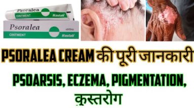 Psoralea Cream/Ointment Benefits, Uses, How to Apply, Price in Hindi | Eczema, Psoriasis, Vitiligo 4 1681260104 hqdefault