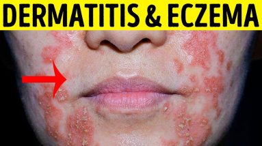 ✅ Dermatitis and eczema || clear skin remedies at home 12 1681260856 maxresdefault