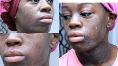 Living With A Rare Skin DISEASE!! | How I cleared My Eczema In 4 Days | De Sade 10 1681261474 maxresdefault