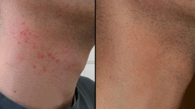 HOW TO CURE RAZOR BURN BUMPS ON NECK & LEGS! 4 1681263221 hqdefault