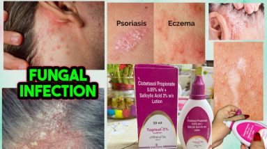 Parmanent treatment of eczema/psoriasis | एक्जिमा खुजली परमानेंट ट्रीटमेंट जड़ से खत्म | Topisal 3 % 18 1681271216 maxresdefault