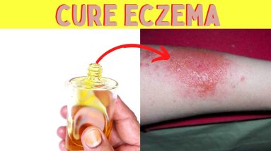 How to cure eczema fast and forever at home on face immediately Cure Eczema 8 1681272903 maxresdefault