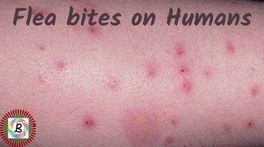 How To Identify Flea Bite Allergies On Humans - كيفية التعرف على حساسية لدغة البراغيث على البشر 8 1681278292 maxresdefault