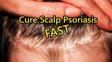 Scalp Psoriasis Home Remedies - How to Cure Scalp Psoriasis FAST 14 1681281958 maxresdefault