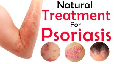 Best Cream for Psoriasis & Eczema (Complete Treatment 3 Units) | MyGiftChimp 8 1681289574 maxresdefault