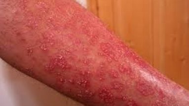 Eczema in Control | Best Eczema Remedies 4 1681294796 hqdefault