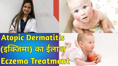Atopic dermatitis (eczema) एक्ज़िमा / एलर्जी दाद खाज खुजली का ईलाज || Eczema Treatment 6 1681295795 maxresdefault