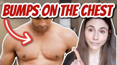 BUMPS ON THE CHEST THAT ARE NOT ACNE //ERUPTIVE VELLUS HAIR CYSTS// DERMATOLOGIST @DrDrayzday 18 1681296620 maxresdefault