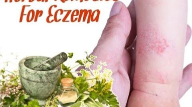Best Herbal Remedies for Eczema 12 1681298114 hqdefault