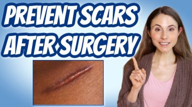 HOW TO PREVENT SCARS AFTER SURGERY 💉 DERMATOLOGIST @DrDrayzday 4 1681300277 maxresdefault