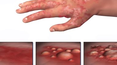 26 DIY Home Remedies To Heal Eczema 18 1681301873 maxresdefault