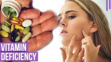 Sneaky Symptoms For Vitamin Deficiency That You Need To Know 16 1681302383 maxresdefault