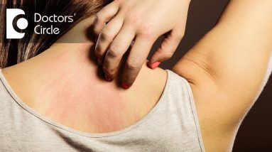 What are the common skin allergies? - Dr. Sachith Abraham 10 1681303938 maxresdefault