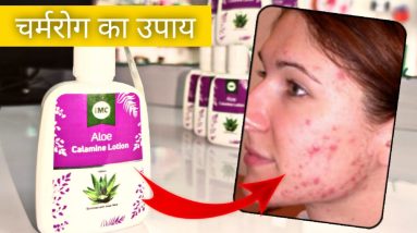 IMC Aloe Calamine Lotion | how to remove Pimples, Acne, Skin Rashes, Eczema, Soriasis, Skin Disease 20 1681304423 maxresdefault