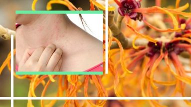 Natural Eczema Treatment: Helps Dry, Itchy Skin : Natural Health Remedies 8 1681309857 maxresdefault