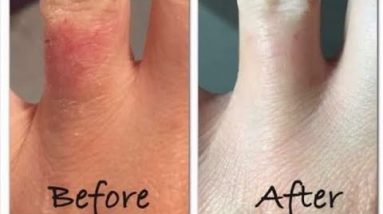 Best Solution of Eczema Problem by Forever Living Products 12 1681319691 hqdefault