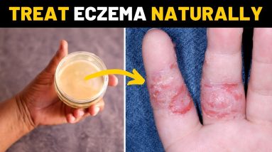 Cure eczema permanently on hands and fingers fast using this homemade cream 8 1681327159 maxresdefault