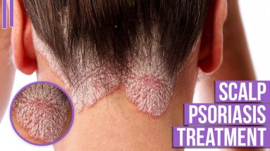 Scalp Psoriasis Treatment at Home 18 1681328381 maxresdefault