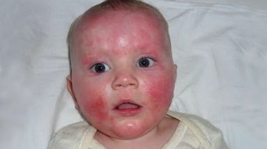 How to Cure Eczema in Babies Naturally : 5 Tips On How To Eczema Home Treatment for Babies 6 1681331952 hqdefault