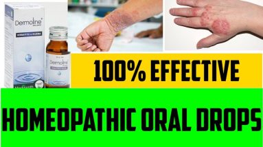 Eczema, Skin Rash, Dermatitis, Itchy Skin Homeopathic Medicine | Dermoline Oral Drops |Review Remedy 14 1681335403 maxresdefault