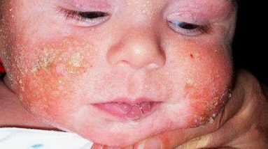 Eczema Home Treatment for Babies : Best Natural Treatment for Eczema in Babies 18 1681339524 hqdefault